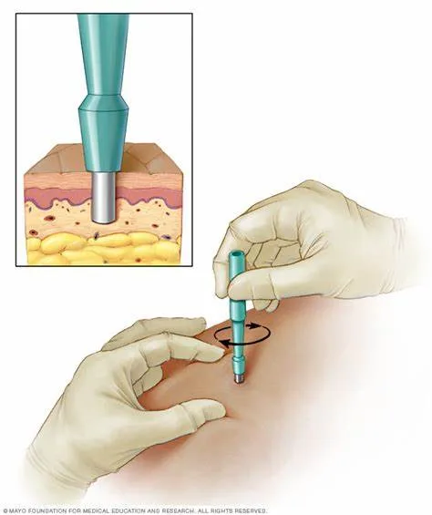 Biopsy Punch how it's done