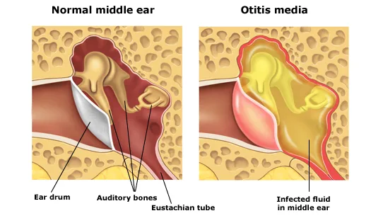 Ear Infection